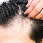 ریزش شدید مو در کمین بهبودیافتگان کرونا