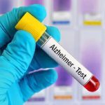 روش‌ های جدید تشخیص آلزایمر