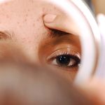 باکتری آکنه و کمک به محافظت از پوست